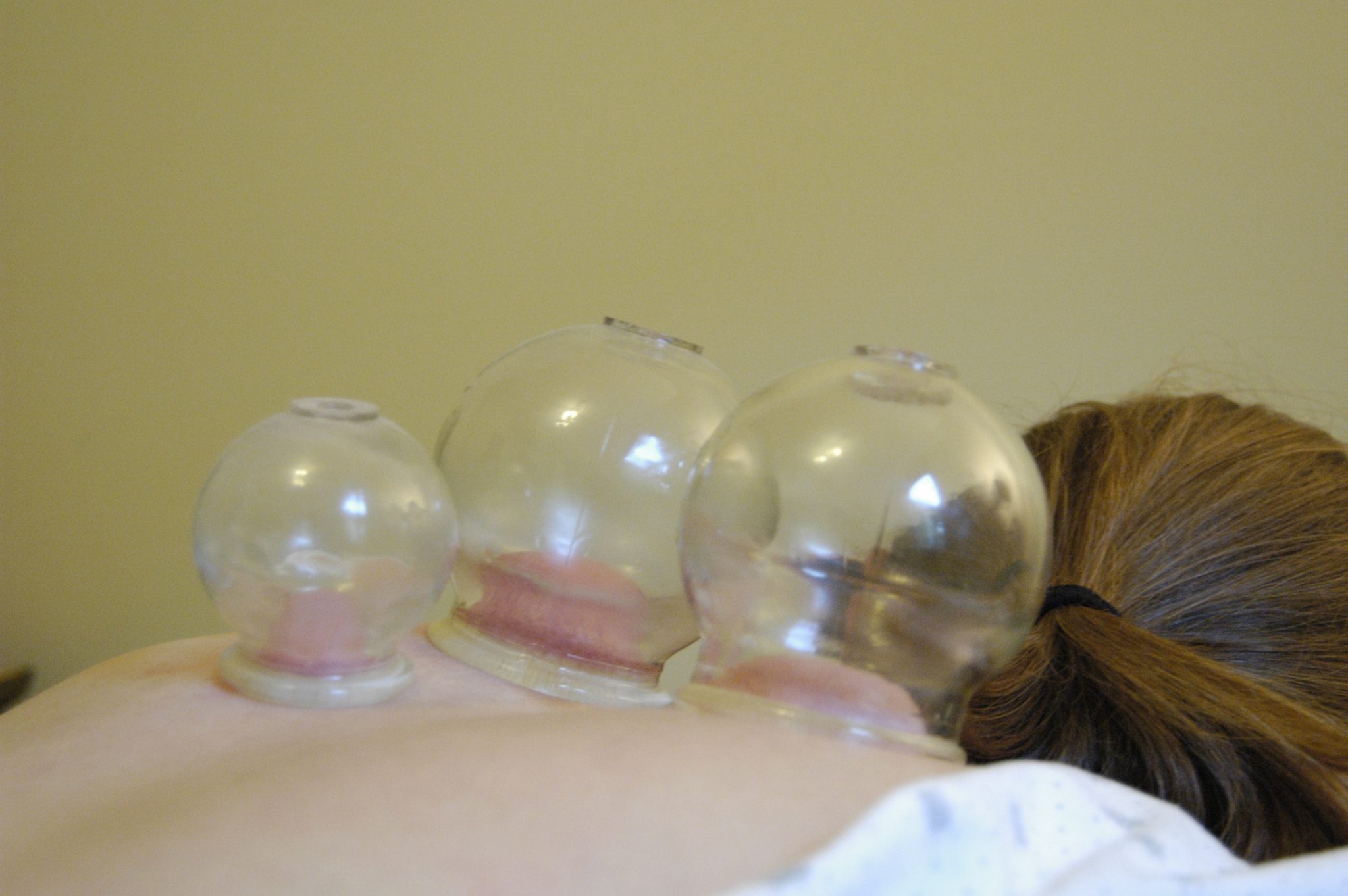 Santa Fe Acupuncture Cups